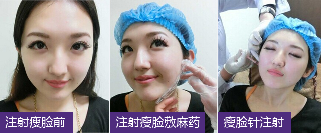美莱瘦脸针,打造最上镜小脸